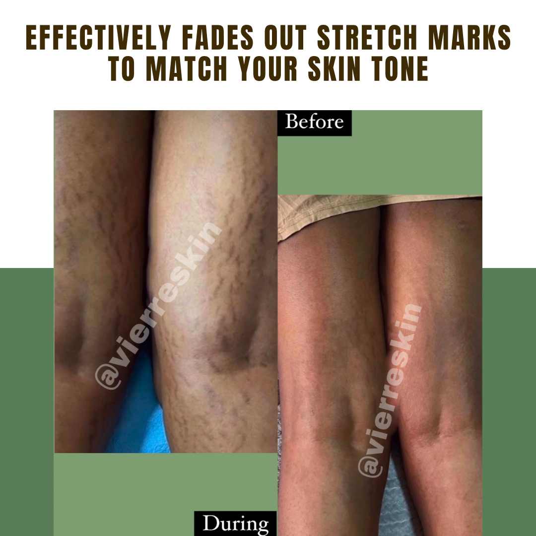 FULL Stubborn Stretch Marks & Scars Kit