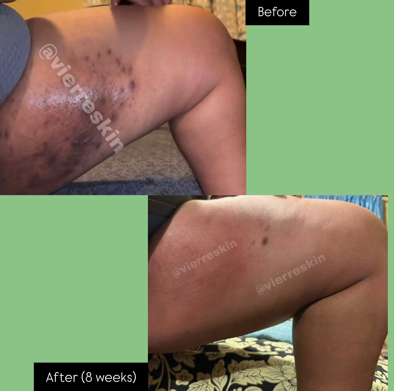 Stubborn Hyperpigmentation & Bikini Kit